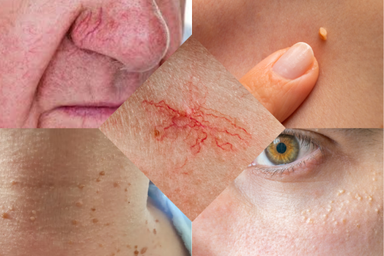 emoveo blemish removal